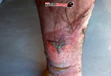 Farid Gazze se recupera de las quemaduras, importantes lesiones…