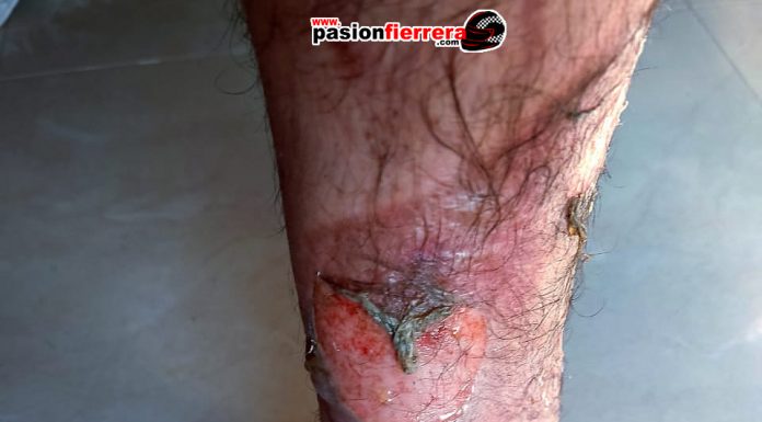 Farid Gazze se recupera de las quemaduras, importantes lesiones…
